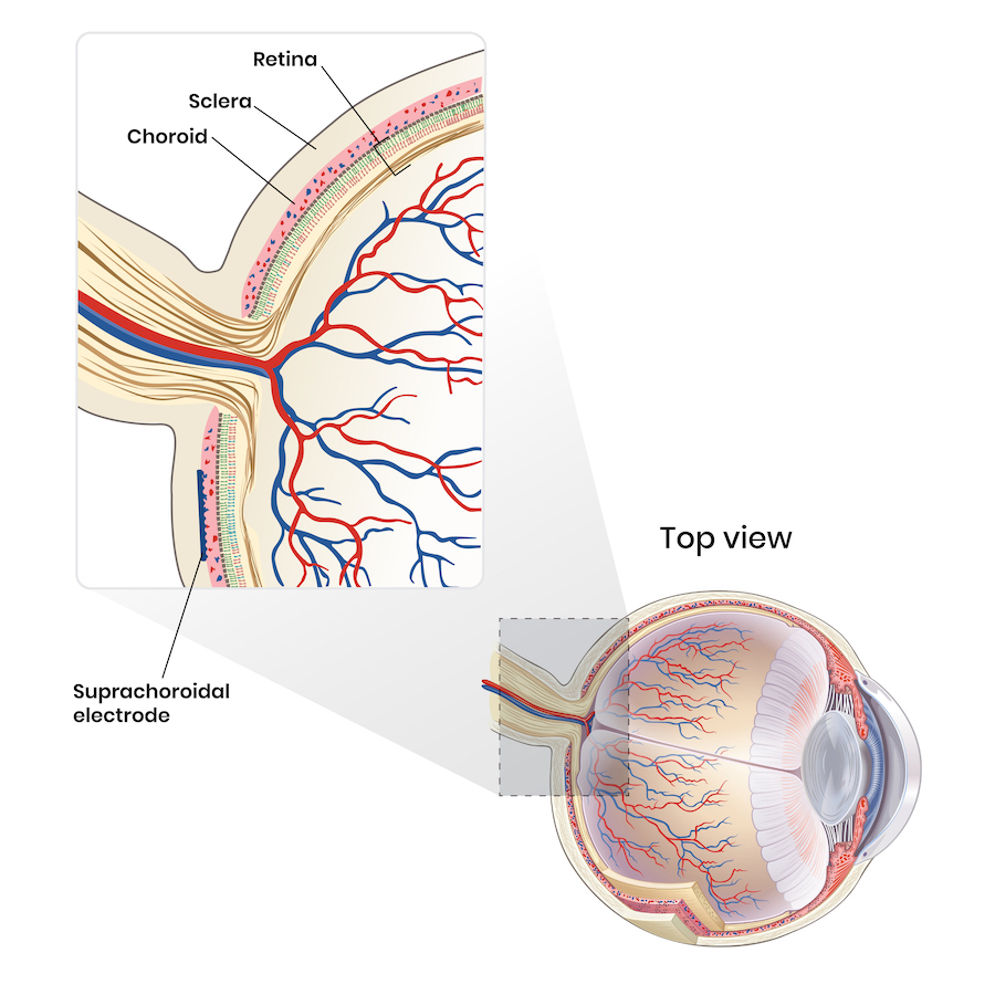Anatomical illustration showing the location of the suprachoroidal electrode in the eye